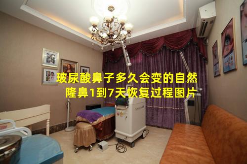 玻尿酸鼻子多久会变的自然 隆鼻1到7天恢复过程图片